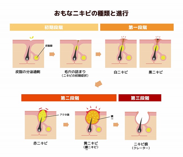 ニキビ